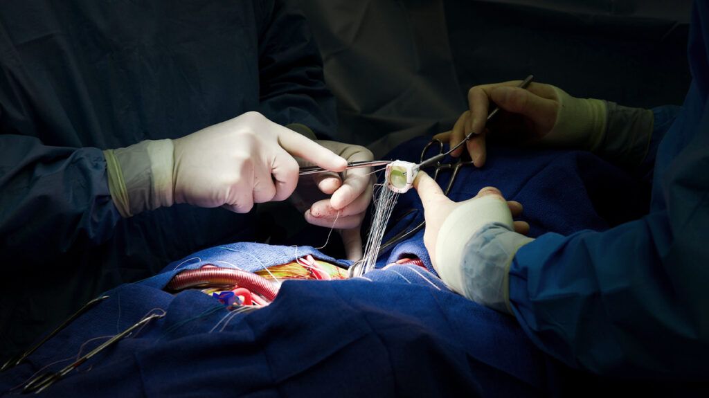 Chirurgie Cardiaque